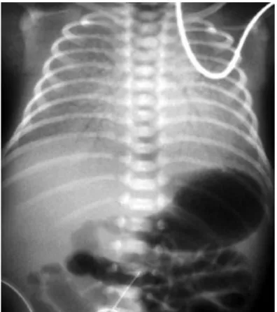 Gambar 2.4 Gambaran paru bayi dengan RDS. Perhatikan paru yang  granular, bronkogram udara, ground glass appearance, ekspansi paru yang 