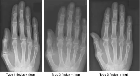Gambar 2.9 Klasifikasi jenis tangan berdasarkan radiograf (Robertson et  al., 2008). 