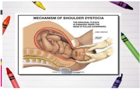 Gambar  2.1: Mechanism  Of Shoulder  Dystocia 