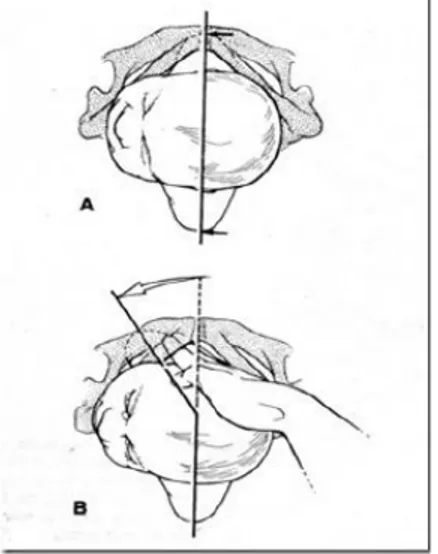 Gambar  2.4.  Manuver  Rubin  II Diameter  bahu  terlihat  antara  kedua tanda  panah,bahu  anak→yang  paling  mudah  dijangkau  didorong  kearah dada anak sehingga  diameter  bahu  mengecil  dan  membebaskan  bahu  anterior  yang  terjepit