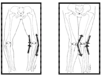Gambar 2.4  Perubahan alignment pada lutut  (Kakarlapudi and Bickeckerstaff, 2000) 