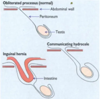 Gambar 2. Patogenesis Hidrokel 
