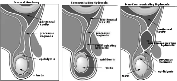 Gambar 3. Jenis-jenis Hidrokel 