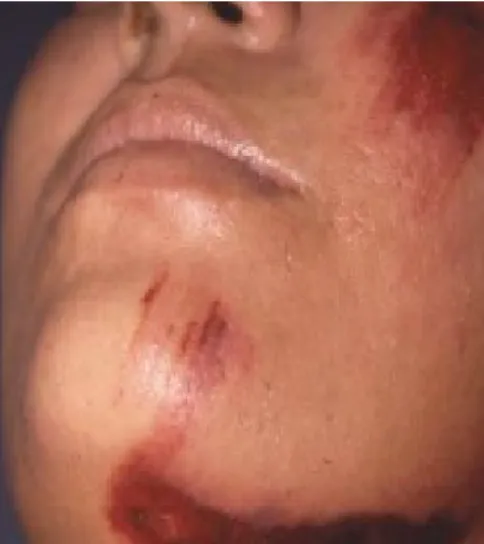 Gambar 9. Wanita 40 tahun dikeluarkan dari  kendaraan bermotor ketika dia menabrak mobil yang sedang diparkir dengan kecepatan tinggi