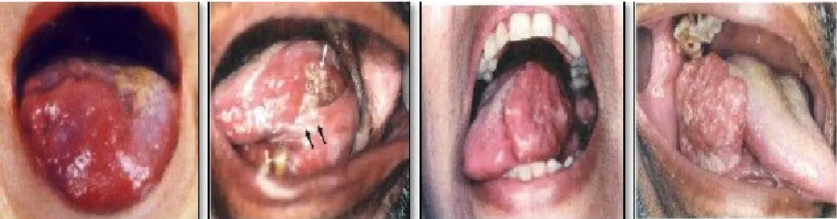 Gambar 8. Gambaran ulkus pada karsinoma lidah 5