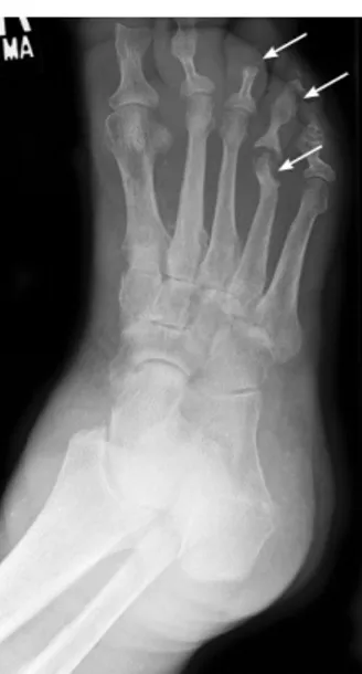 Foto rontgen baru menunjukkan adanya abnormalitas setelah 2 minggu pasca infeksi  karena 50% mineral tulang telah hilang (Gambar 3