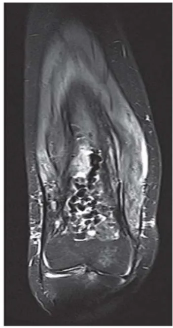 Gambar   4.   Gambaran   rontgen   femur   dari   seorang   wanita   39   tahun   dengan   riwayat  osteomyelitis berulang selama 20 tahun