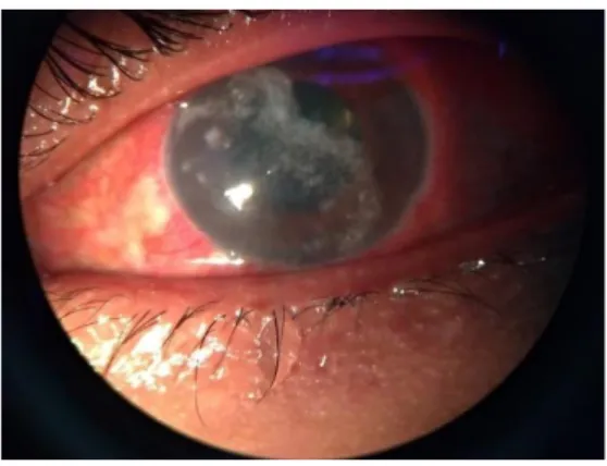 Gambar 2.1 Foto klinis mata kiri pasien tanggal 24 Febuari 2021  