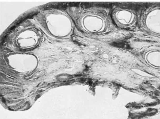 Gambar 2.3 Gambaran patologi polikistik ovarium sindrom  (sumber : DeCherney et al., 2007)