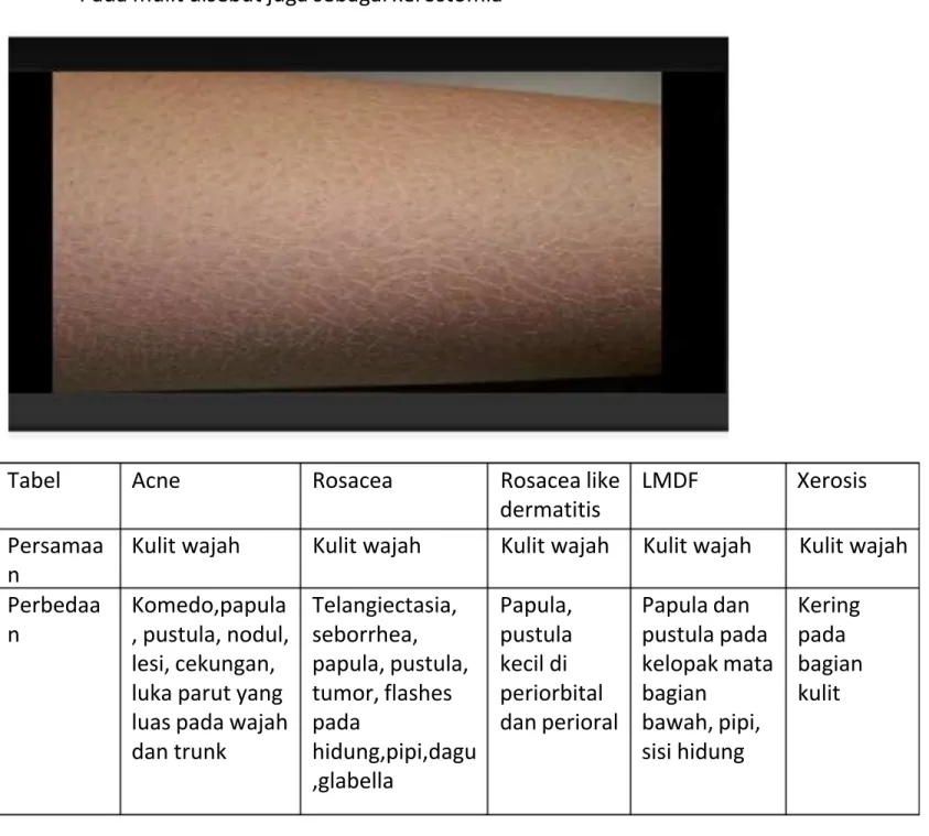 Tabel  Acne  Rosacea  Rosacea like