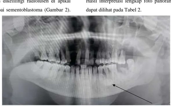 Gambar 2 Gambaran Foto Panoramik, Tanda Panah  (        )  Menunjukkan  Lesi  Sementoblastoma Gigi 35