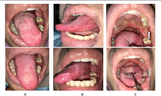 Gambar 4. Setelah diberikan pengelolaan stres lesi mengalami perbaikan: A. Atropi papila pada dorsum lidah (geographic  tongue) mengalami perbaikan; B