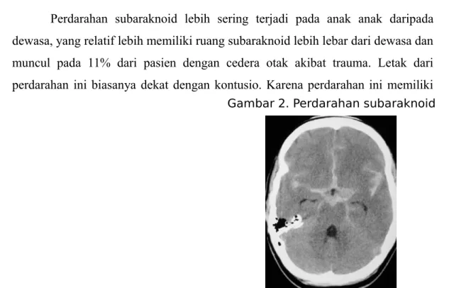 Gambar 2. Perdarahan subaraknoid