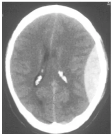 Gambar 3. Perdarahan epidural