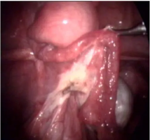Gambar  5.    Jaringan  uterus,  tuba  dan  ovarium  kiri  setelah dilakukan histerektomi + SOS