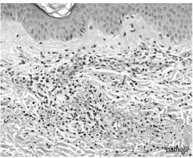 Gambar 3. Gambar mikroskopis Henoch Schonlein Purpura. Vasculitis dengan infiltrasi  sel neutrofil dan debris nekrotik pada dinding pembuluh darah kecil