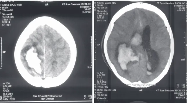 Gambar 1.  CT scan kepala: perdarahan intraserebral, intraventrikular, ventrikulomegali