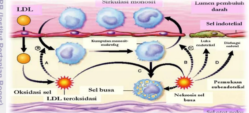 Gambar 8 Patogenesis aterosklerosis (A, LDL teroksidasi menstimuli monosit; B,  mencegah  agresi  monosit;  C,  pembentuk  sel  busa;  D,  oksidasi  LDL  menghasilkan disfungsi endotel dan perlukaan; E, sel-sel busa penyebab  sel  menjadi  nekrosa dan tera