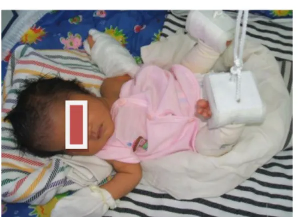 Gambar 1. Traksi pada extremitas bayi 