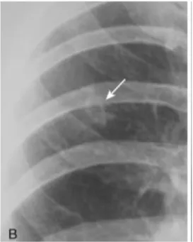 Gambar 2.11 Kavitas pada tuberkulosis paru 