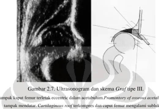 Gambar 2.7. Ultrasonogram dan skema Graf tipe III.