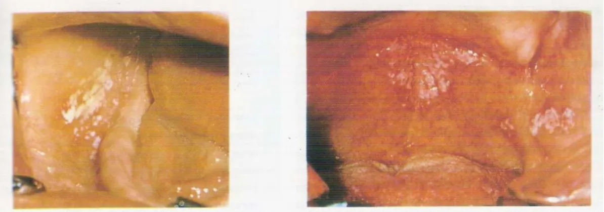 Gambar 2.8 median rhomboid glossitis 13