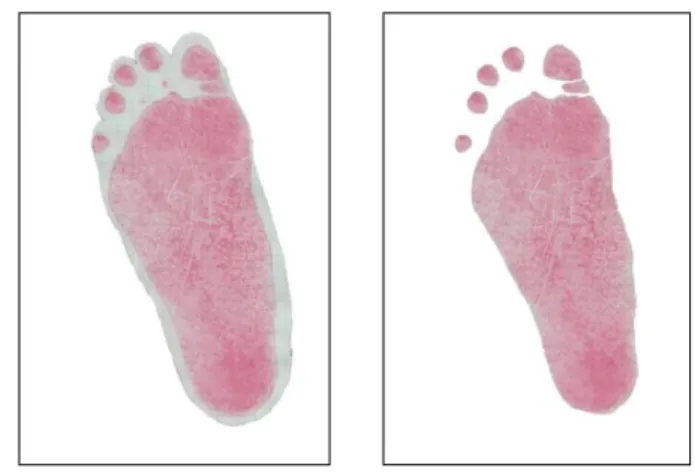 Gambar 2  Telapak kaki flat 