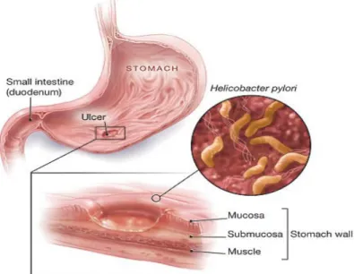Gambar 1. Infeksi bakteri H. Pylori