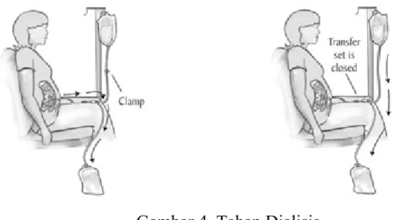 Gambar 4. Tahap Dialisis