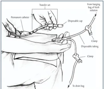 Gambar 6. Perlengkapan Dialisis Peritoneal