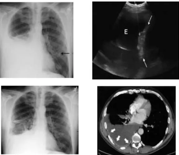Gambar 1. Gambaran radiologi dan USG efusi pleura kanan pada metastasis tumor di paru (atas) dan  gambaran radiologi dan CT- scan toraks seorang pasien laki-laki dengan metastasis kanker  ginjal   di paru (bawah)