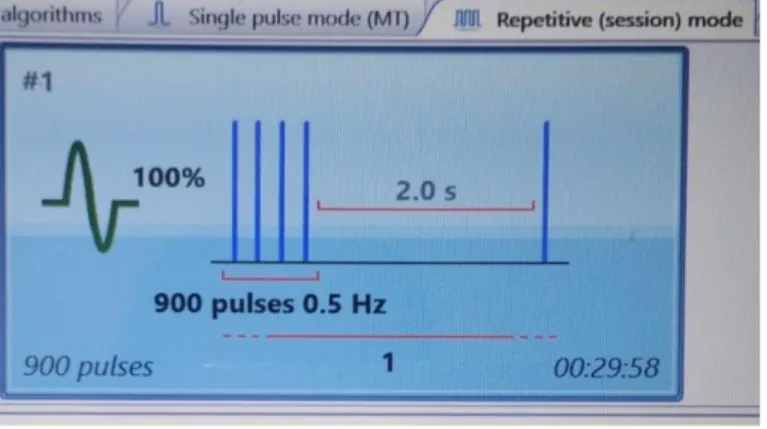 Gambar  1.  Terapi    low-frequency  rTMS  0,5Hz  dengan  kekuatan  100%,  menggunakan 900 pulsa selama 30 menit