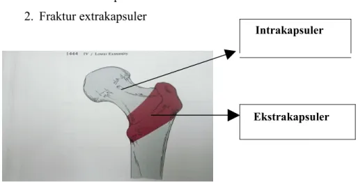 Gambar 6: Fraktur intrakapsuler dan ekstrakapsuler