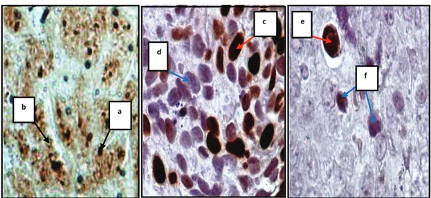 Gambar 1.  Ekspresi AgNORs (A), MIB-1 (B), dan Caspase-3 (C) pada preparat biopsi  kanker serviks (original 10x100)