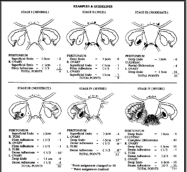 Gambar 2.4  Klasifikasi endometriosis The American Fertility Society yang telah  direvisi  (Sumber: Fertil Steril 1997;67:820)
