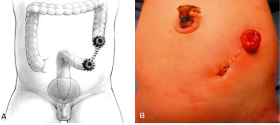 Gambar 7. Kolostomi yang ideal pada neonatus dengan malformasi anorektal letak tinggi