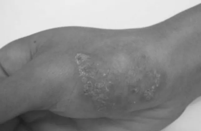 Gambar 1.  Tuberkulosis Kutis Verukosa, sebelum  terapi (hari ke-1) 
