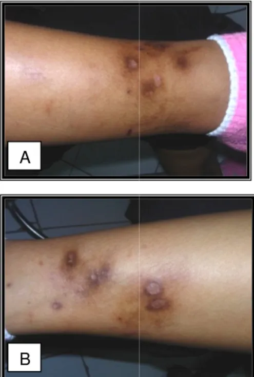 Gambar 3A dan 3B.   Lesi kulit setelah 3 bulan pengobatan mengalami  perbaikan  berupa  skar  atrofik  dengan  area  sekitarnya  berupa makula hiperpigmentasi.
