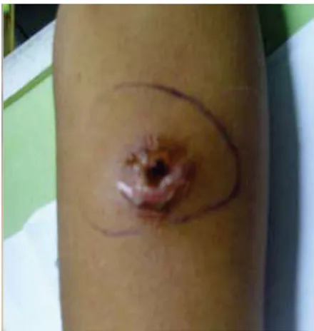Gambar  3. Lengan  kanan pasien dengan  luka  borok, 2  minggu setelah dilakukan uji Mantoux
