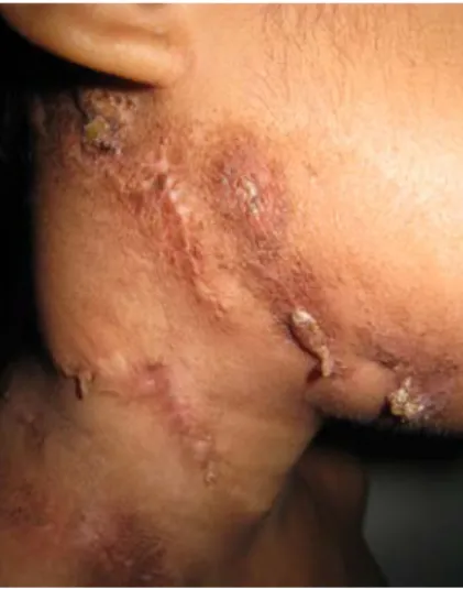 Gambar 4. Lesi yang menutup tampak di regio colli dextra dan  submandibula dextra setelah 3 bulan pengobatan.