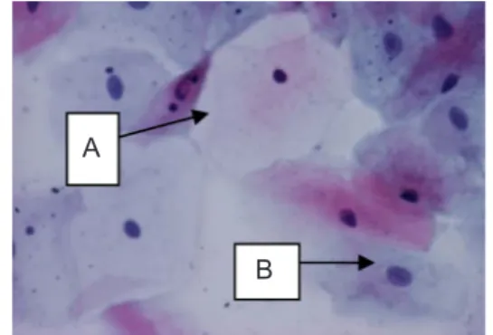 Gambar 7.  Sel  Superfisial  Hapusan  Mukosa  Bukal  dengan  pembesaran  400X  dengan A (sel superfisial) dan B (sel  intermediet)