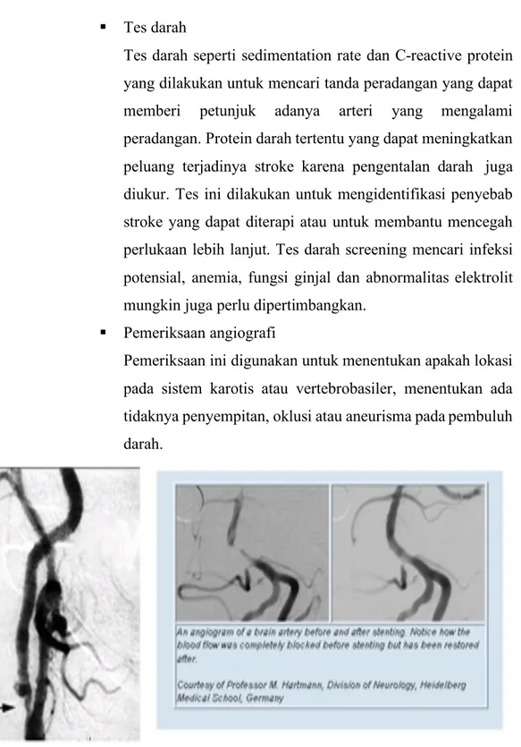 Gambar 2. Gambaran Angiografi Pada Penderita Stroke 