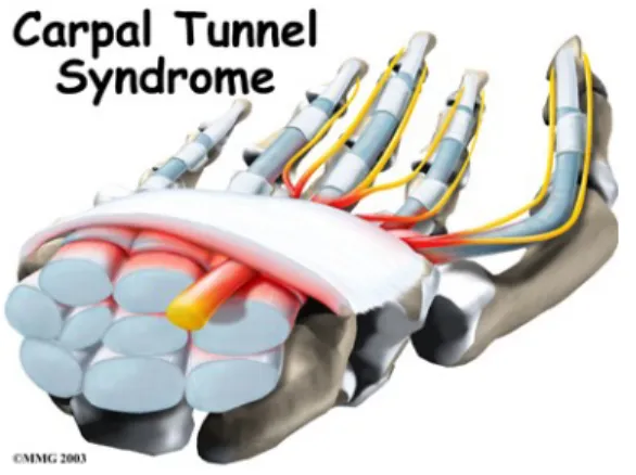 Gambar 2.3 Carpal Tunnel Syndrome