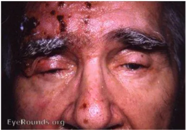 Gambar 1. Herpes zoster oftalmikus sinistra. 