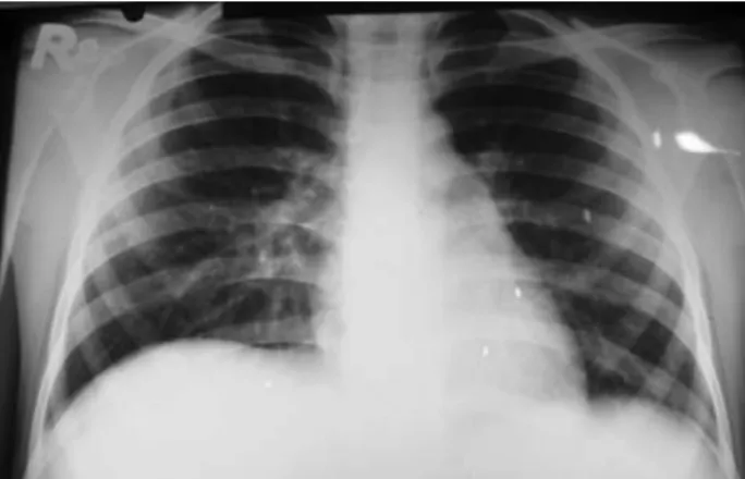 Gambar 2. Gambar radiologi dada saat awal masuk rumah  sakit