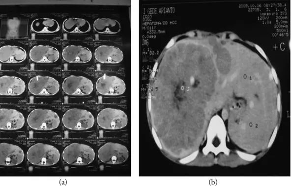 Gambar 3. Gambar CT-scan abdomen dengan kontras (a+b)