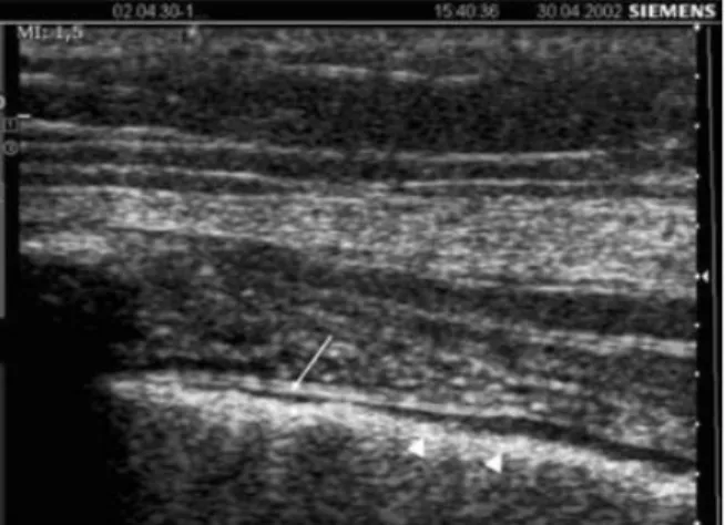 Gambar 1 Normal Pleura dengan transduser  jenis linier(7) 
