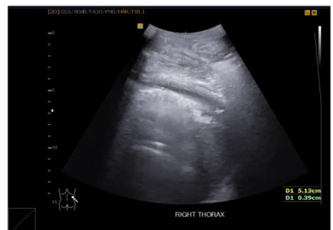Gambar 6 Hasil USG Pasien 2 dengan efusi  pleura minimal di sinus kostofrenikus kanan  disertai dengan edema sub cutis di soft tissue  hemithorax lateral bawah kanan.