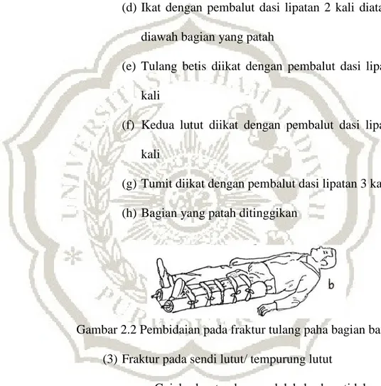 Gambar 2.2 Pembidaian pada fraktur tulang paha bagian bawah  (3)  Fraktur pada sendi lutut/ tempurung lutut 