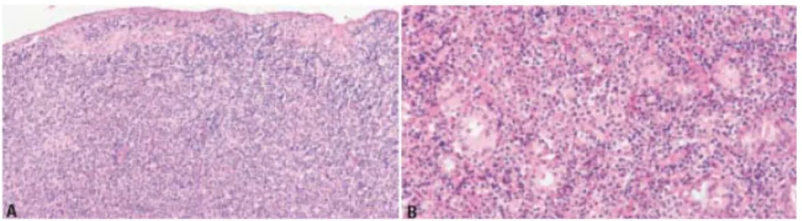 Gambar 2.3. Nasal NK/T cell lymphoma. A. Mukosa intak dan terlihat sebaran infiltrat  sel-sel limfoma